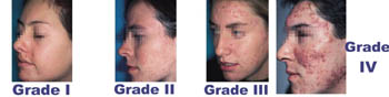 Grade I, II, III acne can use Differin.  Differin NOT approved for Grade IV cystic acne