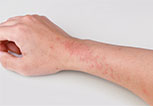 Eucrisa for Eczema is non steroidal and can be used from head to toes -arms