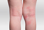 Eucrisa Eczema can be used anywhere from head to toes