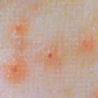 Comedones, papules and a few pustules in Grade II acne