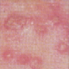 Comedones, papules, pustules and a few nodules are characteristic of Grade III acne