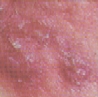 Comedones, papules, pustules, nodules, cystes characteristic of Grade IV acne