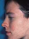 Grade II acne consisting of mostly comedones and papules