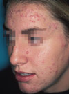 Grade III acne consisting of comedones, papules, pustules and a few nodules