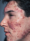 Grade II acne consisting of comedones, papules, pustules, nodules and cysts