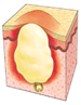 Grade IV acne lesion diagram