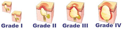 Skin diagram of the different stages of acne - Epiduo Gel Acne Treatment