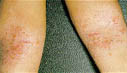 Eczema - Atopic Dermatitis lesions: Elidel Cream Eczema treatment