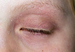 Eucrisa NEW topical Eczema - can even be used on eyelids