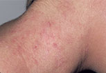 Eucrisa Eczema Ointment can be used anywhere neck