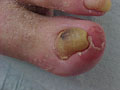 Severe fungal nail infection - not a candidate for Penlac prescription treatment