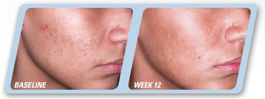 Epiduo Gel Acne Treatment 12 weeks treatment (adapalene vitamin a retinoid and benzoyl peroxide)  significant improvement