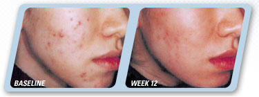 Epiduo Gel Acne Treatment 12 weeks treatment (adapalene vitamin a retinoid and benzoyl peroxide)  significant improvement