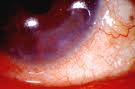 Ocular Rosacea