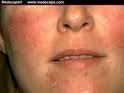 Soolantra Rosacea treatment Ivermectin Online