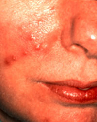 Rosacea bumps - Ivermectin rosacea treatment online