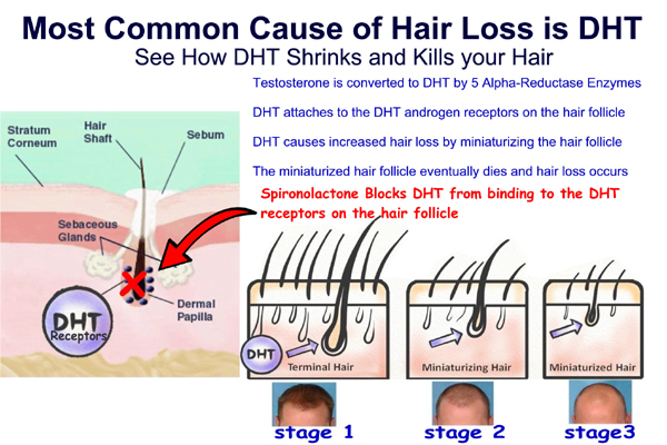 Topical Spironolactone Prescription for Hair Loss Online -  Testosterone is converted to DHT by 5 Alpha-Reductase Enzymes  Spironolactone BLOCKS the DHT receptors on the hair follicle itself