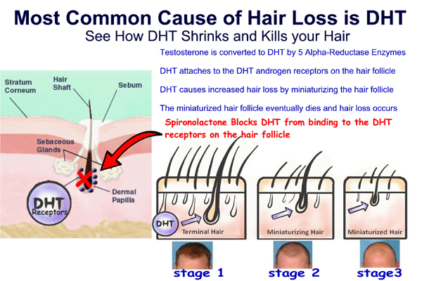 Topical Spironolactone Prescription for Hair Loss Online - Testosterone is converted to DHT by 5 Alpha-Reductase Enzymes Spironolactone BLOCKS the DHT receptors on the hair follicle itself