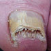 Severe nail fungus -toenail fungus