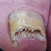 Severe fungal infection - not a candidate for Penlac presription treatment