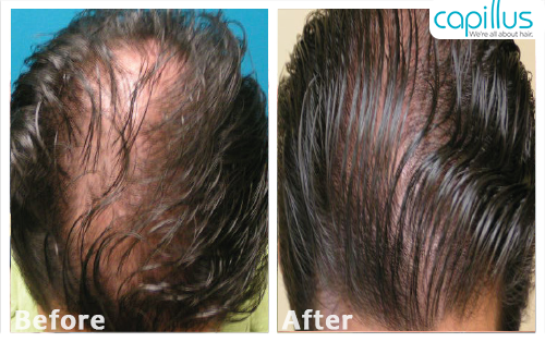 Capillus Before After Hair Restoration