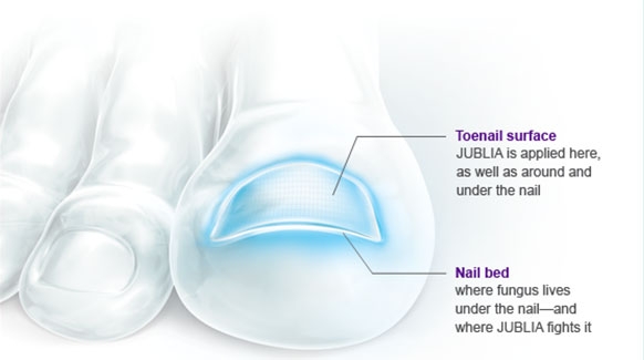 Jublia topical solution FDA approved toenail antifungal treatment