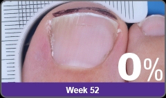 Jublia toenail fungal treatment - new FDA approved topical prescription