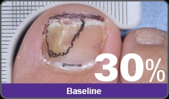 Jublia toenail fungal treatment - new FDA approved topical prescription