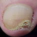 Penalac antifungal treatment recommended for moderate fungus infection of nails