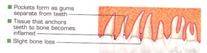 early periodontitis  - Periostat prescriptionn