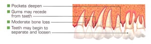 Periostat prescription:  periodontitis moderate