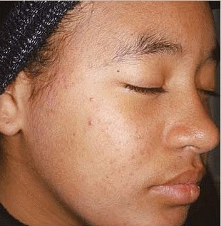 12 weeks after Aczone (Dapsone) gel treatment for acne