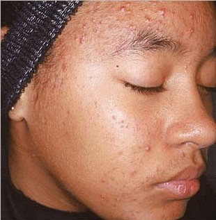 Before Aczone (dapsone) gel treatment for acne