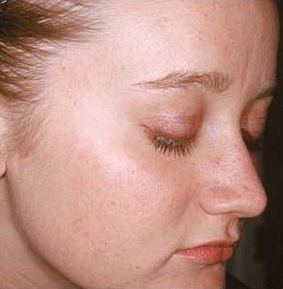 12 weeks after Aczone (Dapsone) gel treatment for acne