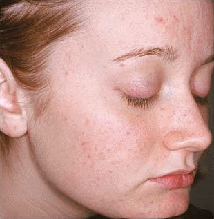 Before Aczone (dapsone) gel treatment for acne