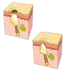 Blackheads (open comedones) White heads (closed comedones)
