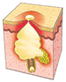 Grade III acne lesion diagram